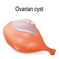 Ovarian cyst