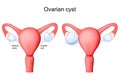 Ovarian cyst. Human uterus with fluid-filled sac within the ovary
