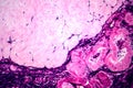 Ovarian cyst, light micrograph