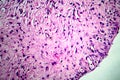 Ovarian cyst, light micrograph