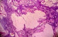 Ovarian cyst, light micrograph, photo under microscope