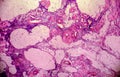 Ovarian cyst, light micrograph, photo under microscope Royalty Free Stock Photo