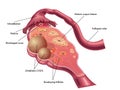 Ovarian cyst Royalty Free Stock Photo