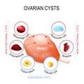 Ovarian cyst