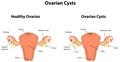 Ovarian Cysts