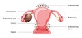 Ovarian endometriomas chocolate cysts Female reproductive system uterus problem diagram with inscriptions. Human medical