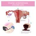 Ovarian lesions may trap menstruating blood, which from cysts kn