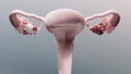 Ovarian malignant tumor, Female uterus anatomy, Reproductive system, cancer cells, ovaries cysts, cervical cancer, growing cells