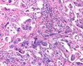 Ovarian mucinous cystadenocarcinoma