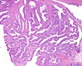 Ovarian mucinous cystadenocarcinoma