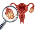 Ovaries concept Royalty Free Stock Photo