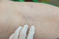 over time, moles and other spots grow on the skin