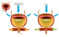 Overactive bladder OAB and Normal bladder.Illustration showing Detrusor muscle contracting when and before bladder is