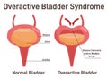 Overactive bladder syndrom. Normal bladder and bladder with urinary Royalty Free Stock Photo