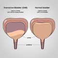 Overactive and normal bladder. Urinary system disease Royalty Free Stock Photo