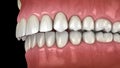 Overbite dental occlusion Malocclusion of teeth . Medically accurate tooth animation