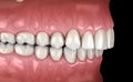 Overbite dental occlusion Malocclusion of teeth . Medically accurate tooth illustration