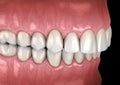 Overbite dental occlusion Malocclusion of teeth . Medically accurate tooth 3D illustration