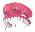 Overdenture to be seated on implants attachments