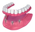 Overdenture to be seated on implants - ball attachments. Royalty Free Stock Photo