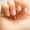 Overgrown cuticle fingernails and tainted nail plate. Gel nail polish fell off. Royalty Free Stock Photo