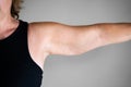 Overweight Lady Arm With Excess Fat