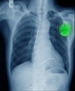 Pacemaker cell in chest x-ray of patient in blue tone Royalty Free Stock Photo