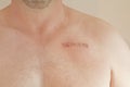 Pacemaker scar Royalty Free Stock Photo