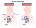 Pacemaker types overview compares traditional dual-chamber and leadless devices Royalty Free Stock Photo