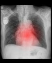 Pacemaker on x-ray