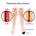 PAD. Peripheral Artery Disease. Vascular disease