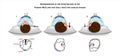 Pagnini McClure roll test for canalolithiasis vector