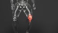 Pain in the arthritic knee joint, Knee painful, skeleton x-ray, arthritis, osteoarthritis. Meniscus, Tendon problems and Joint