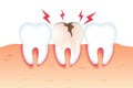 Pain in Broken Tooth Illustration Realistic 3d.