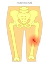 Pain in the hip joint_femur fracture