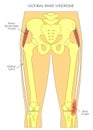 Pain in the hip joint iliotibial band syndrome