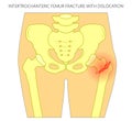 Pain in the hip joint_intertrochanteric femur fracture with dislocation Royalty Free Stock Photo