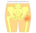 Pain in the hip joint_intertrochanteric femur fracture Royalty Free Stock Photo