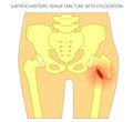 Pain in the hip joint_subtrochanteric femur fracture with dislocation Royalty Free Stock Photo