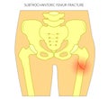 Pain in the hip joint_subtrochanteric femur fracture Royalty Free Stock Photo