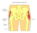 Pain in the hip joint_trochanteric bursitis Royalty Free Stock Photo