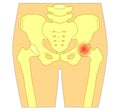 Pain in the hip joint