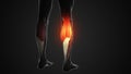 Pain and injury in the Gastrocnemius Muscles