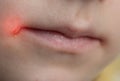 Pain and itching in the corners of the lips of a girl's mouth. Seizures on the skin, bacterial dermatological
