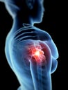 Pain in the shoulder joint