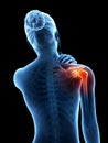 Pain in the shoulder joint