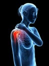 Pain in the shoulder joint