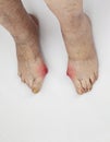 Pain syndrome and deformation of the foot with arthritis.