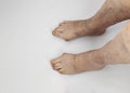 Pain syndrome and deformation of the foot with arthritis.