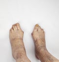 Pain syndrome and deformation of the foot with arthritis.